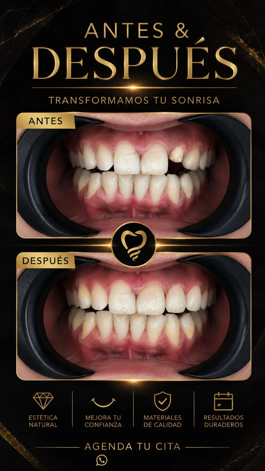 Corona de zirconia: antes y después